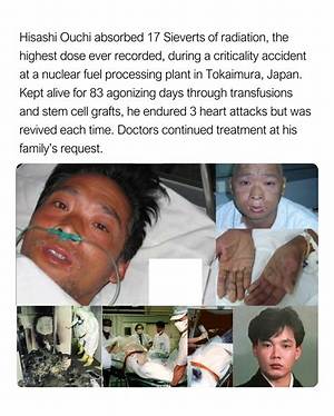 Hisashi Ouchi Medical Photos: a Tragic Case of Radiation Exposure
